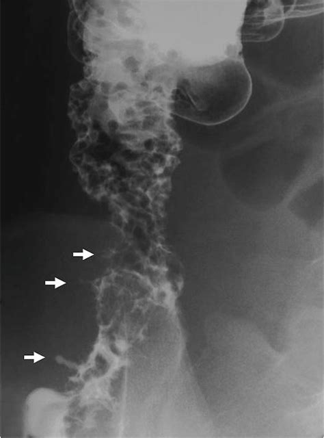 Double Contrast Barium Enema Of The Colon Showing Inflammation Of The