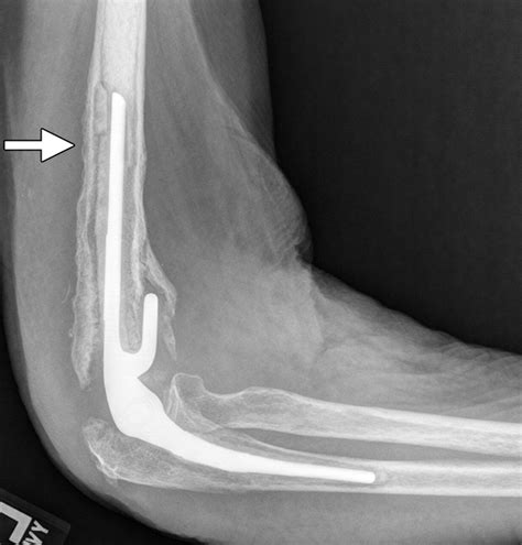 Radiologic Review Of Total Elbow Radial Head And Capitellar