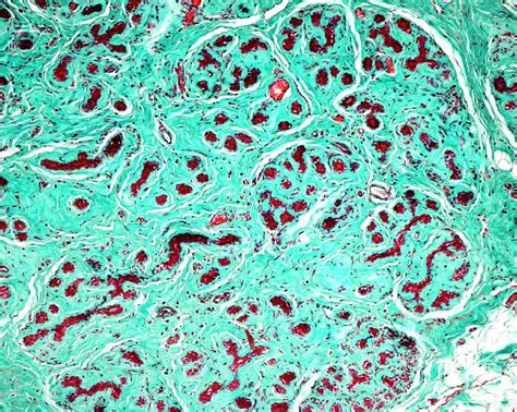 Breast Fibrosis Photograph By Jose Calvoscience Photo Library Pixels