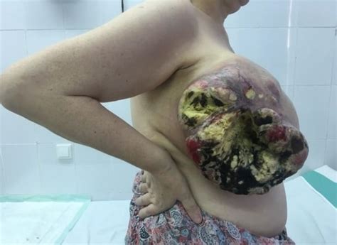 【閲覧注意】乳がんの女性のヌードがほぼ出回らない理由（画像あり） ポッカキット