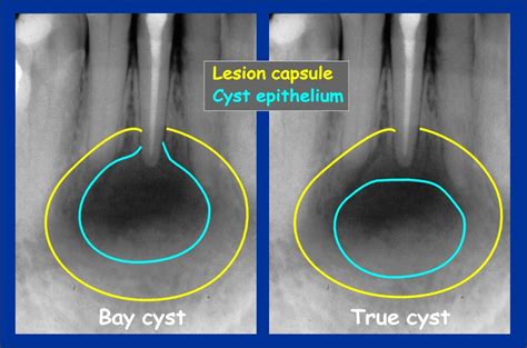 Bay Cyst And True Cyst