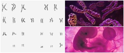 Anomalías Cromosómicas ¿qué Son ¿cómo Ocurren Anomalías Numéricas Anormalidades