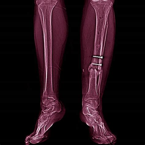 Royalty Free Xray Broken Leg Pictures Images And Stock Photos Istock