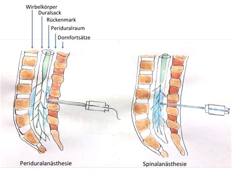 Bei erkrankungen, bei denen es zu einem reizungszustand der hierbei wird in sitzender lagerung und nach lokaler betäubung der haut das medikament mit einer. Periduralanästhesie - Spinalanästhesie: Was ist der ...