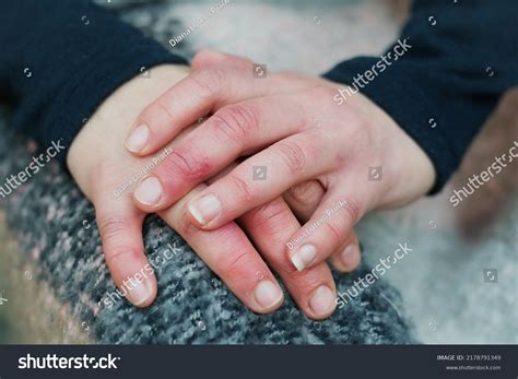 Womans Hands Wounds Raynauds Syndrome Circulatory Stock Photo