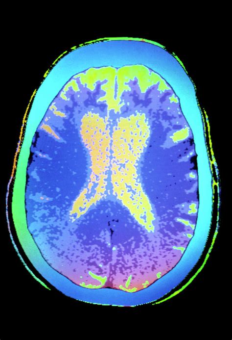 Coloured Ct Scan Of Brain With Alzheimers Disease Photograph By Gjlp