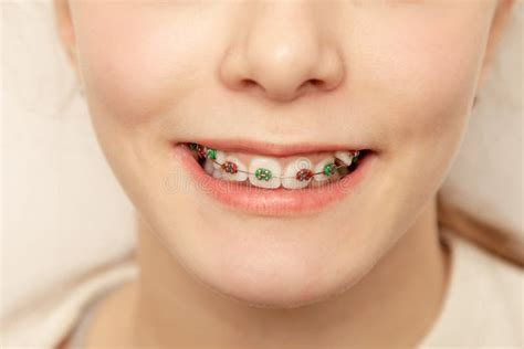Closeup Multicolored Red And Green Braces On Teeth Beautiful Female Smile With Braces