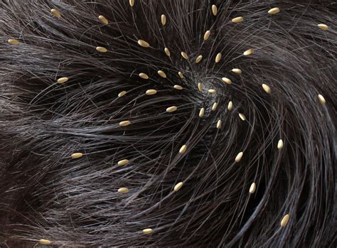 Details More Than 80 Causes Of Hair Lice Best Ineteachers
