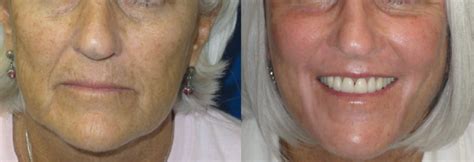 Laser Skin Resurfacing Before And After Pictures Orlando