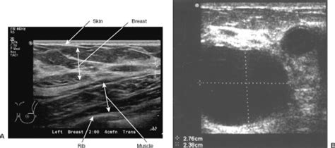 Ultrasound Guided Breast Interventions Basicmedical Key