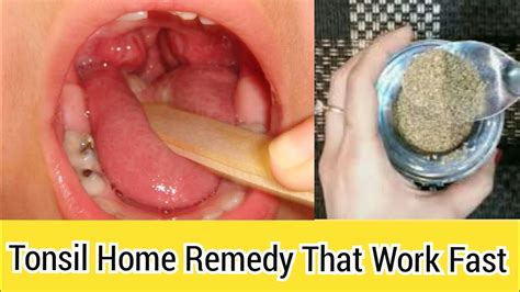 Cure Tonsillitis Fast Without Antibiotic Amazing Home Remedy That Work