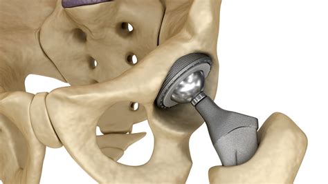 Hip Replacement Anterior Vs Posterior Surgery Recovery Time