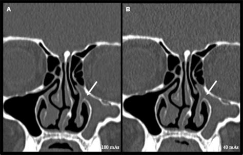 Coronal Reformatted Images Of Mdct Scans Obtained At 10 Open I