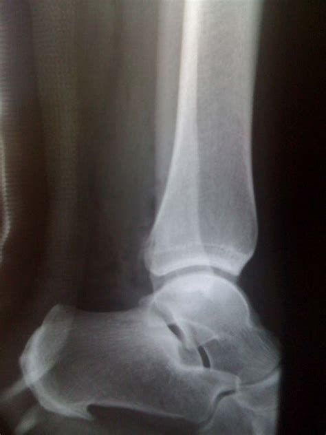 Ganglion Cyst Of The Distal Tibia A Case Report The Foot And Ankle
