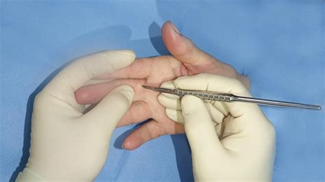 Ganglion Higrom prsta s malom kvržicom i velikom smetnjom Ganglion cyst removal Finger