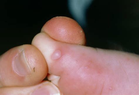 Image Coxsackie Virus A Exanthem Foot Lesions Msd Manual