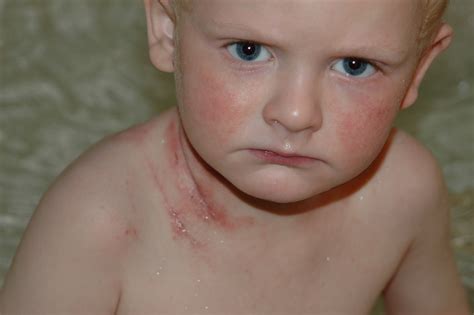 Klines Road From Out Of Control Eczema To Topical Steroid Withdrawal