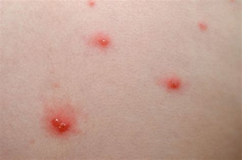 Are Cold Sores From Chickenpox