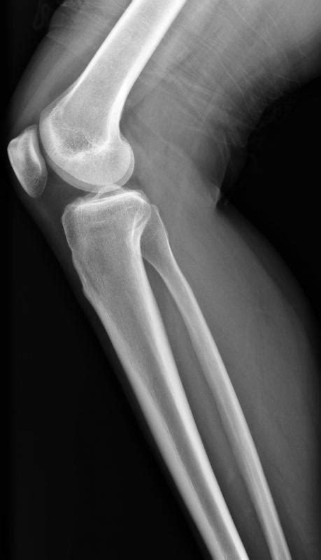 What Is A Spiral Fibula Fracture With Pictures