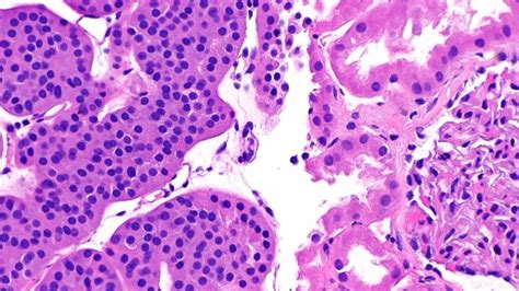 The Oncocytoma Is A Tumor Composed Of Oncocytes Epithelial Cells