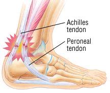 The achilles tendon or heel cord, also known as the calcaneal tendon, is a tendon at the back of the lower leg, and is the thickest in the human body. Tendonitis Guide: Causes, Symptoms and Treatment Options