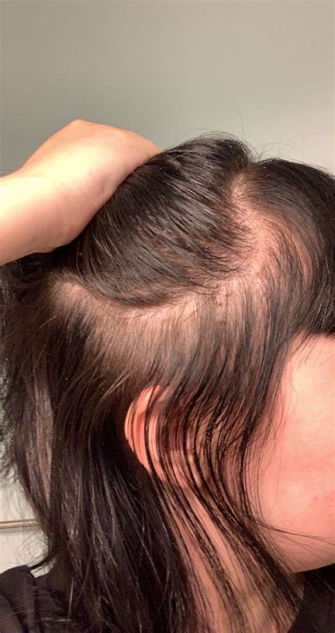 In Your Opinion Would You Say My Hair Is Thinning Rfemalehairloss