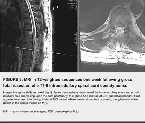 Figure 1 From Dural Tear During Thoracic Laminectomy Using Craniotome