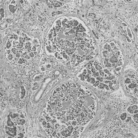 Pdf Portal Vein Tumor Thrombus Of Liver Metastasis From Lung Cancer