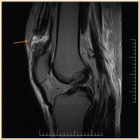 Quadriceps Tendon Rupture MRI Sumer S Radiology Blog