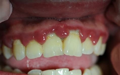 Management Of Periodontal Disease Aids Institute Clinical Guidelines