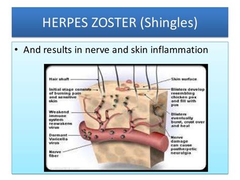 Herpes Zoster By Dr Bashir Ahmed Dar Associate Professor Medicine Sop