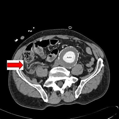 Appendicitis Concise Medical Knowledge