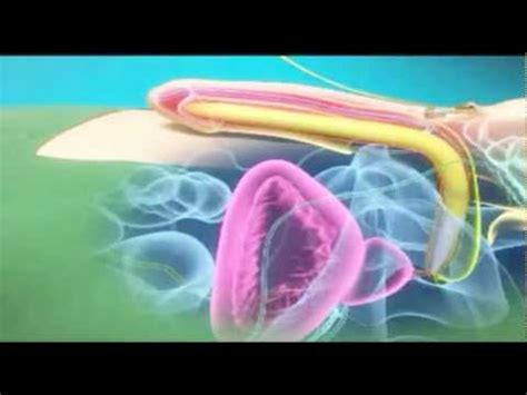 Erectile Dysfunction Penile Prosthesis Implantation For Erectile