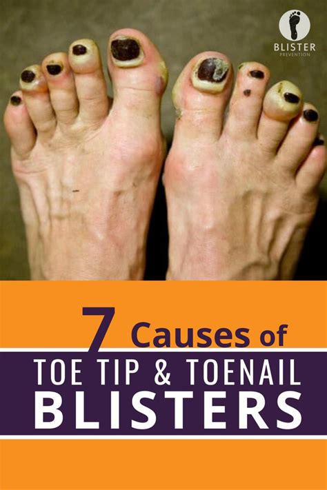 7 Causes Of Toe Tip And Toenail Blisters Toenail Blisters Toe Tip