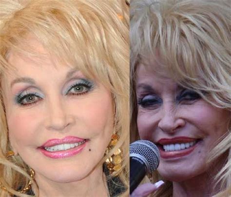 Dolly Parton Plastic Surgery Breast Increase Eyelid Surgery Nose Job