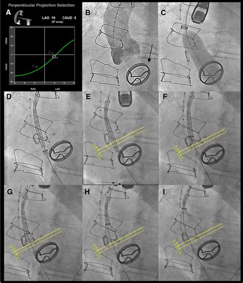 Figure 1 From Transcatheter Aortic Valve Implantation Of A Corevalve