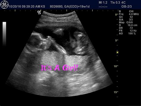 Ultrasound Of Fetus At 14 Weeks