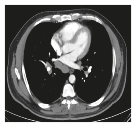 Ct Chest Showing Bilateral Mediastinal And Hilar Adenopathy Download