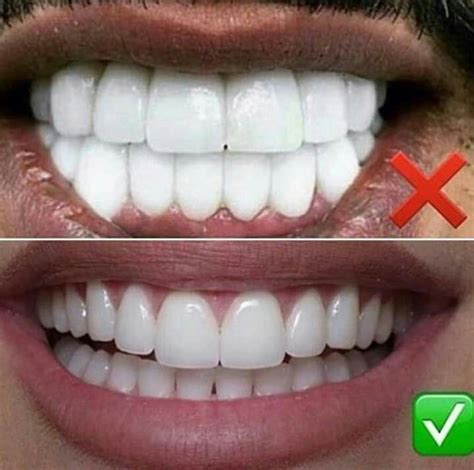 Blog Dentist Ceremic Veneers Teeth Dental Veneers Beautiful Teeth