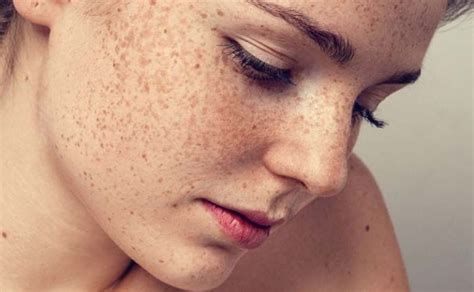What Is Melasma Symptoms Causes Diagnosed And Treatment