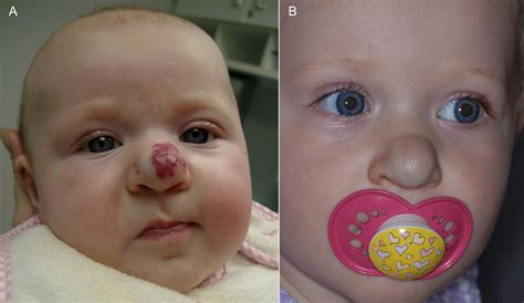 Diagnosis And Management Of Infantile Hemangioma American Academy Of