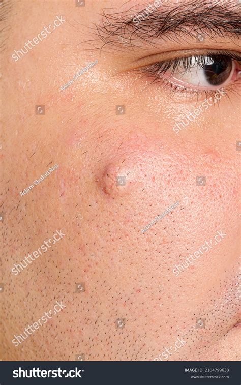 Sebaceous Cyst On Man Face Close Stock Photo 2104799630 Shutterstock