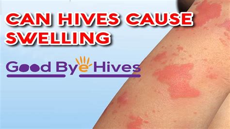 Can Hives Cause Swelling 👩‍⚕️ And What Leads To Swelling Youtube