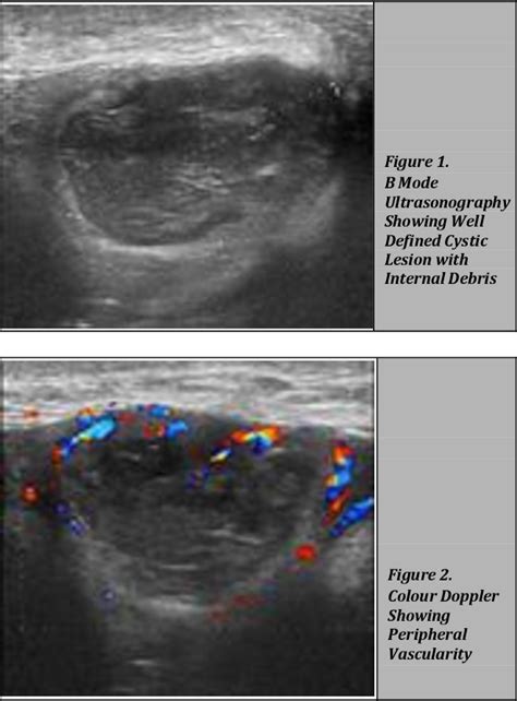 Figure From Infected Bartholin Cyst Ultrasonography Doppler Magnetic Resonance Evaluation