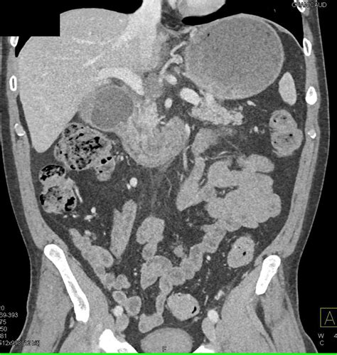 Duodenal Adenocarcinoma Causes Gastric Outlet Obstruction Small Bowel