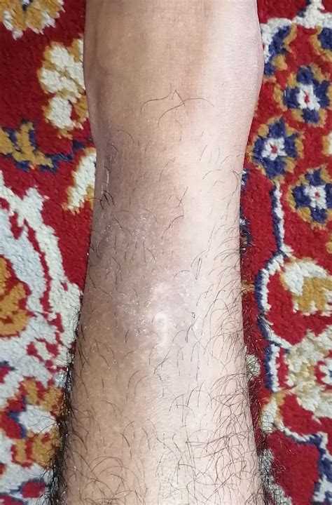 Ask A Dermatologist Online For Itchy Patch On Left Leg Near Ankle