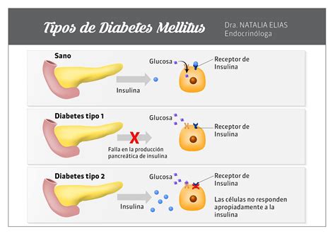 Tipos de Diabetes Cuáles son los síntomas signos y tratamientos TVSana