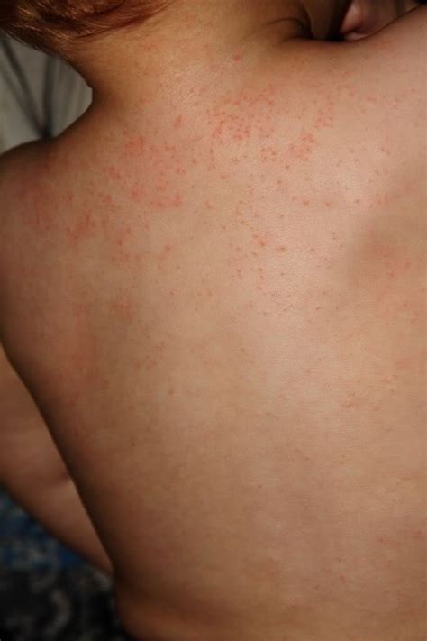 How To Get Rid Of Heat Rash In Two Days Musely