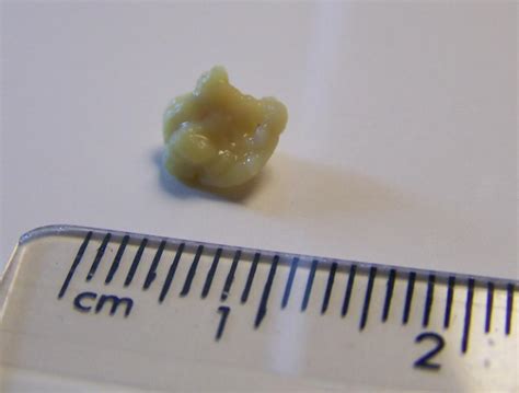 Tonsil Stones Causes Symptoms And Treatment