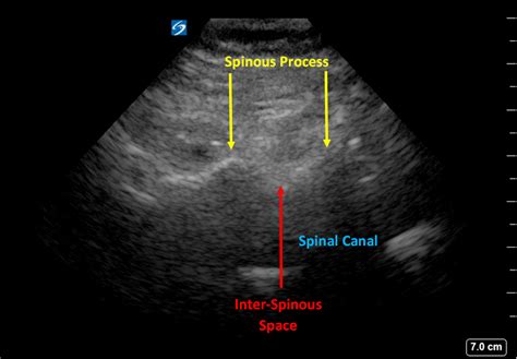 Getting To The Point Of Ultrasound Assisted Lumbar Punctures Sonomojo